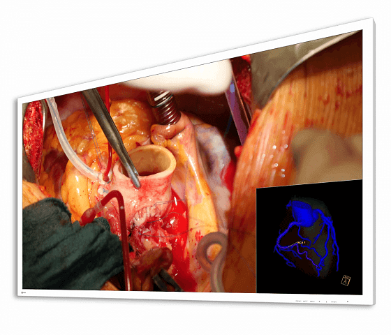 CuratOR EX5841 58" Ultra HD 4K LED Surgical Display