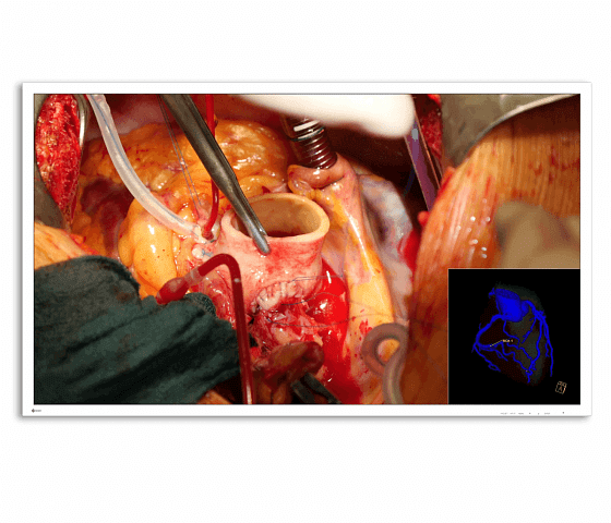 CuratOR EX5841 58" Ultra HD 4K LED Surgical Display