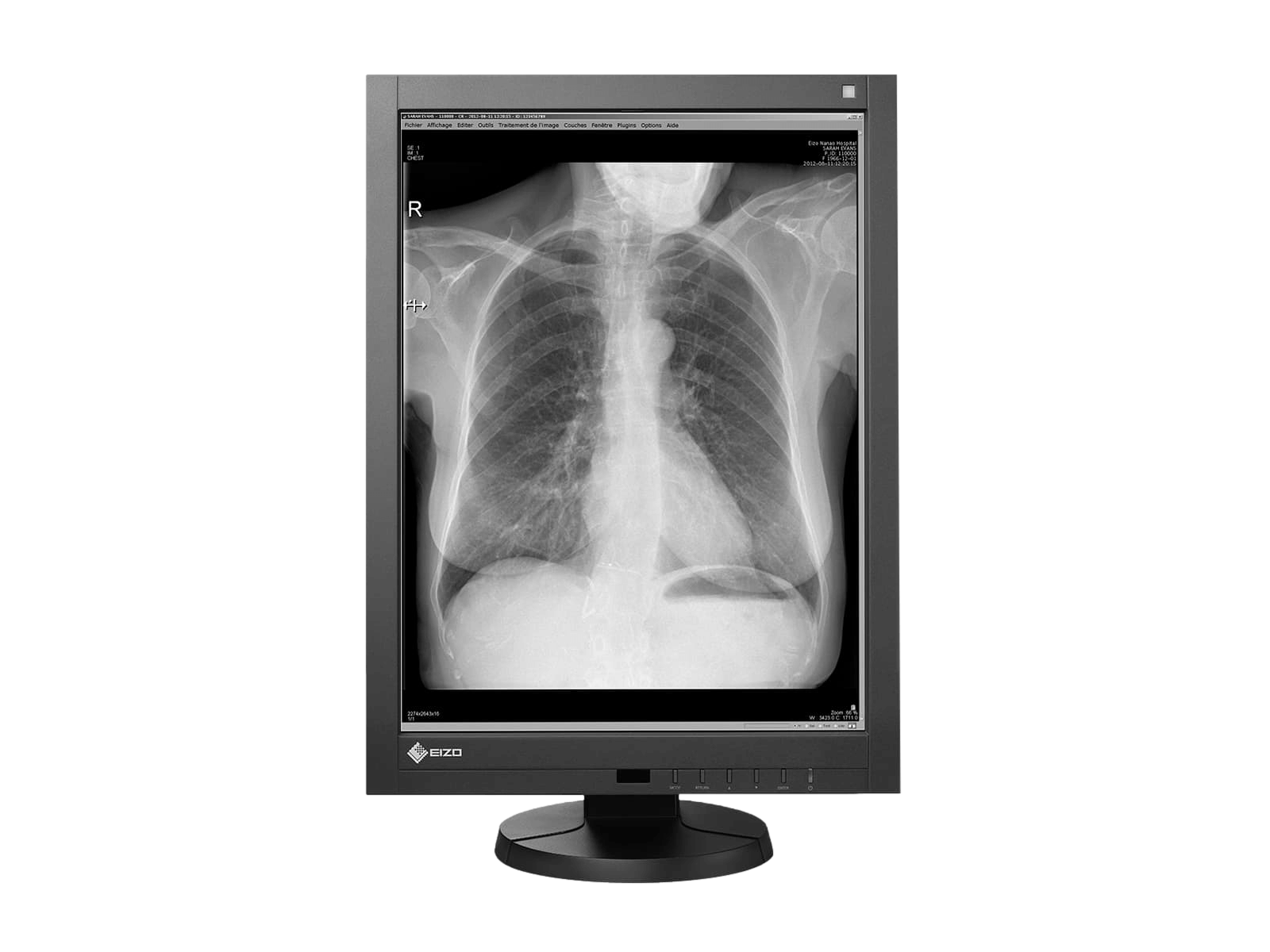 Medical monitor RadiForce GX340 3MP 21.3" LCD LED Monochrome Display is ideal for CR with its 3MP high resolution, displaying an entire chest image with great accuracy 